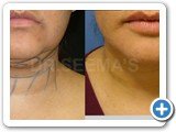 face-and-neck-liposuction-1